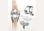 膝関節部品 | インプラントイメージ